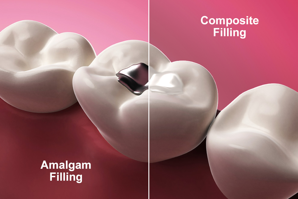 Amalgam (Silver) Fillings at Chompers Pediatric Dentistry & Orthodontics, San Francisco