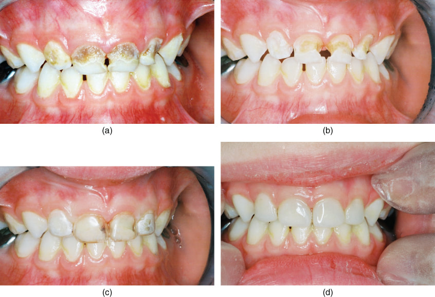 ​Composite (tooth-colored crowns) - For Front Teeth