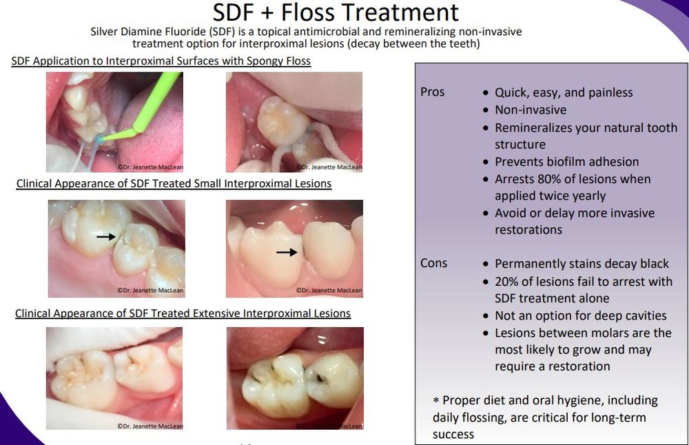 SDF + Floss Treatment